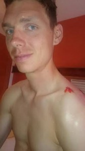 Tony Martin_Clavícula